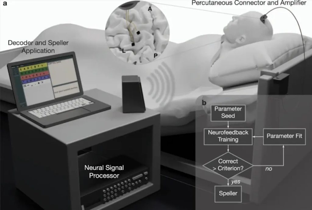 implant-mozgu-sla-komunikacja-pacjent-system