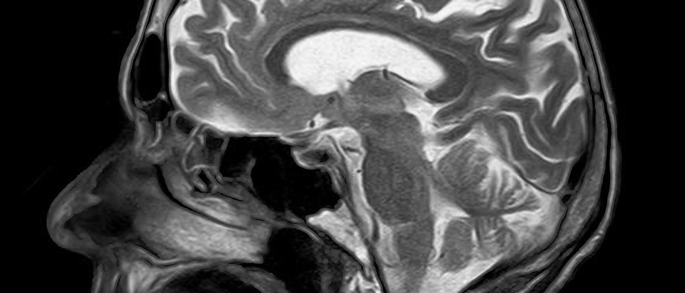 rezonans magnetyczny rak mózgu Intel Penn Medicine